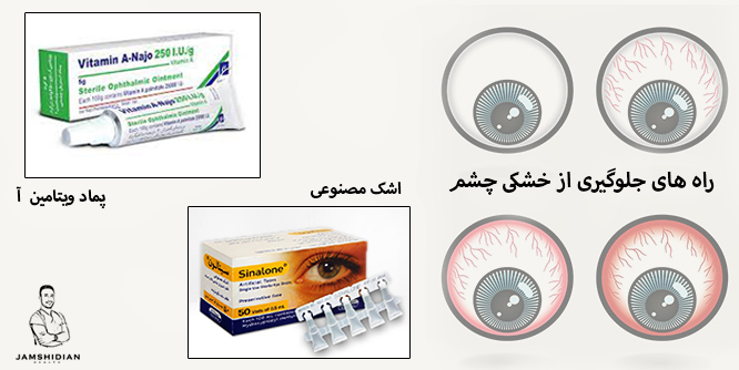 راههای جلوگیری از خشکی چشم: اشک مصنوعی،پمادویتامین آ 