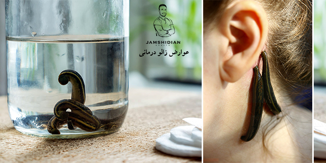 عوارض زالو درمانی